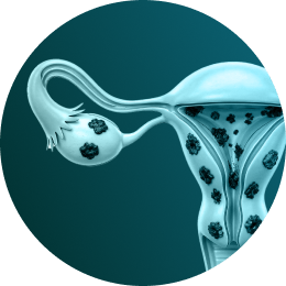 Endometriose Imagem Endometriose